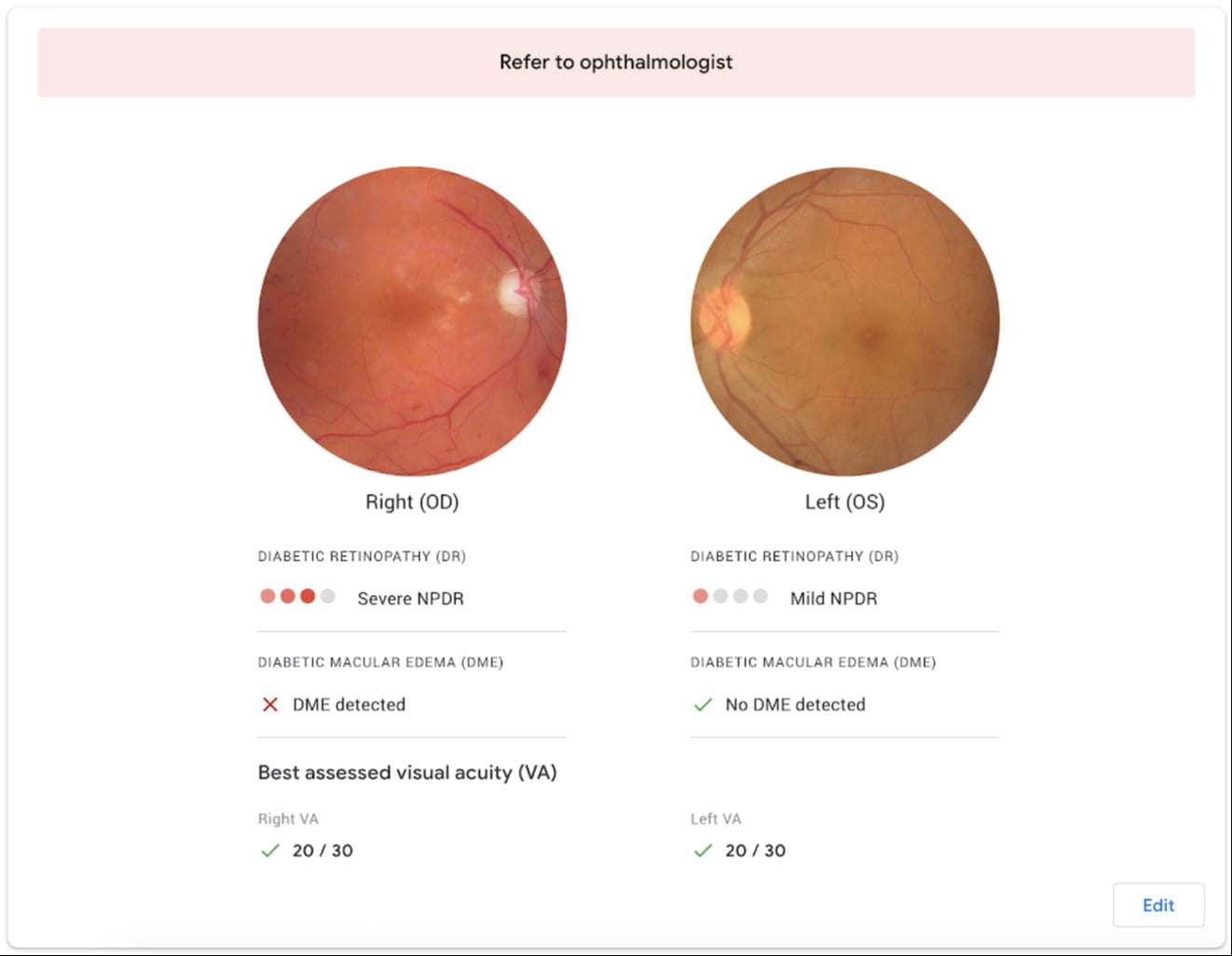 Die KI analysiert die Augenaufnahmen auf Auff&auml;lligkeiten, die auf eine Krankheit hinweisen. Entdeckt sie diese, verweist sie auf einen Augenarzt. Bild: Google